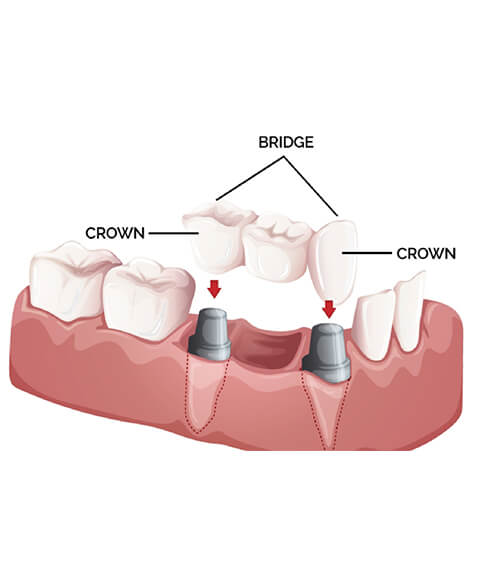 Dental Crowns & Bridges