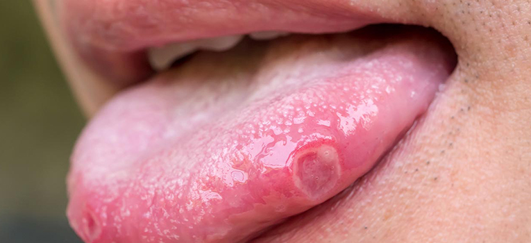 Tongue ulcer