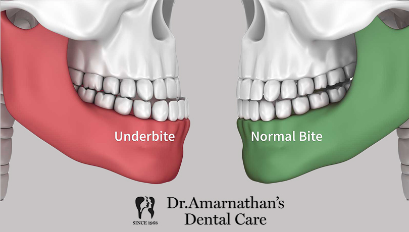 Underbite