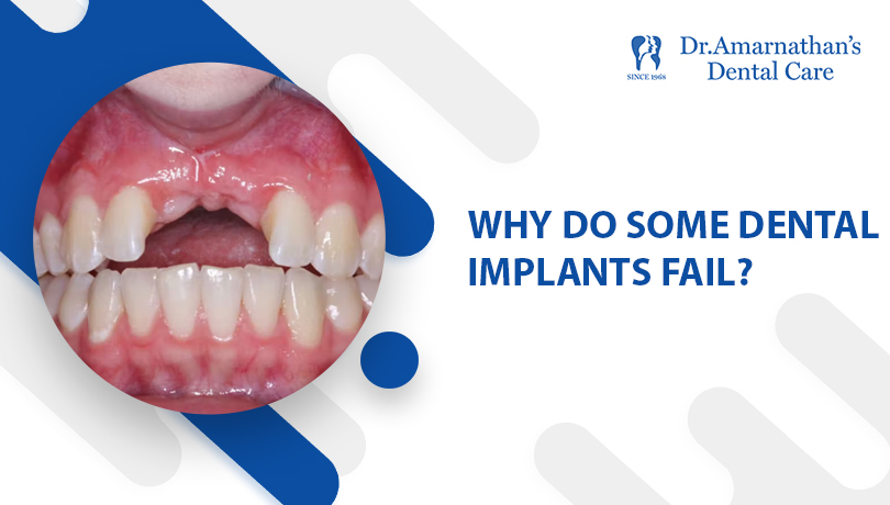 Why do some dental implants fail?