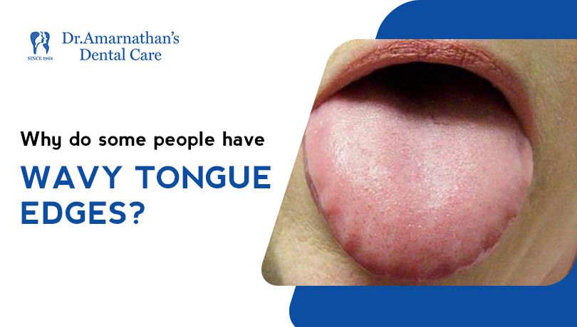 Scalloped Tongue | Crenated Tongue