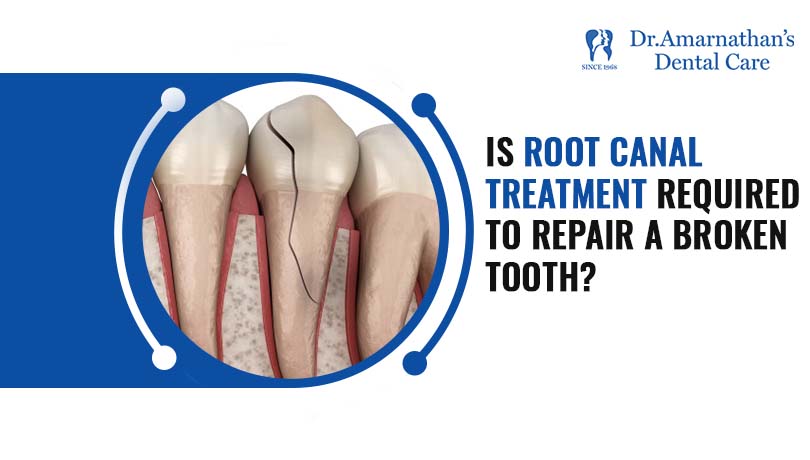 Is Root Canal Treatment mandatory to treat a broken tooth?