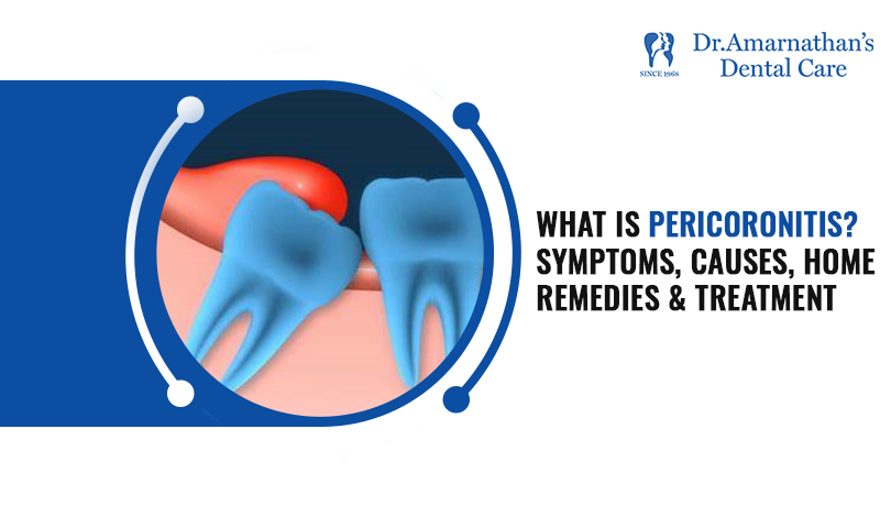 What is Pericoronitis? Symptoms, causes, home remedies & treatment
