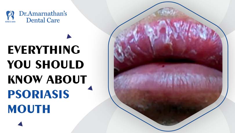 Everything you should know about Psoriasis Mouth