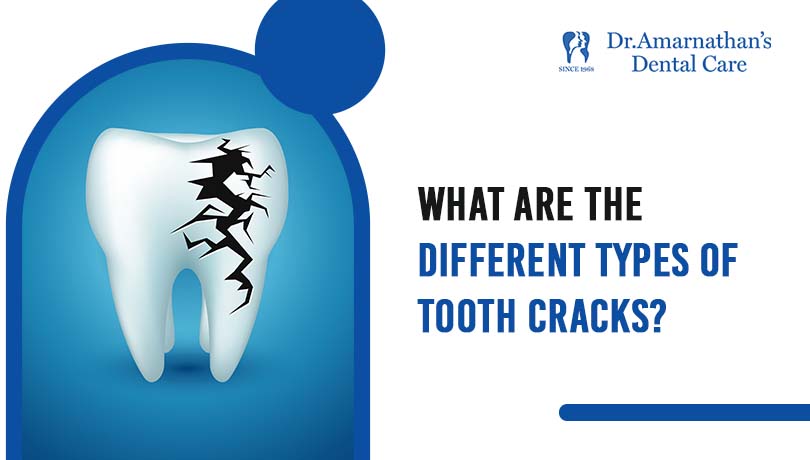 What are the different types of tooth cracks?