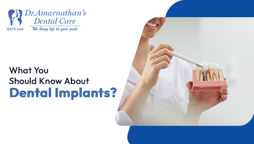 What You Should Know About Dental Implants?