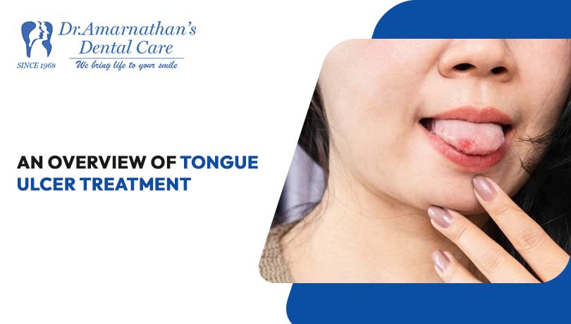 An Overview of Tongue Ulcer Treatment